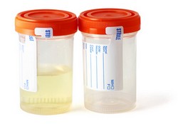 Grossesse et analyse des urines 