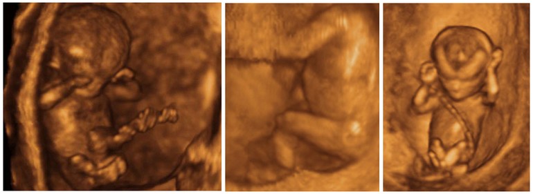 Echographies foetus 13ème semaine de grossesse