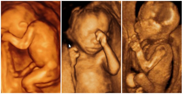 Développement du foetus 18 semaines de grossesse