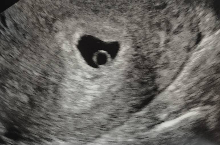 Echographie à 2 semaines de grossesse