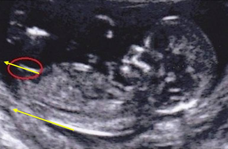 Le foetus est une fille !