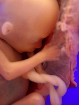 Foetus 18ème semaine de grossesse