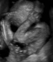 Echographie d'un foetus de 7 mois