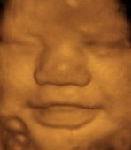 Foetus de face