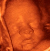 Foetus échographie 3D