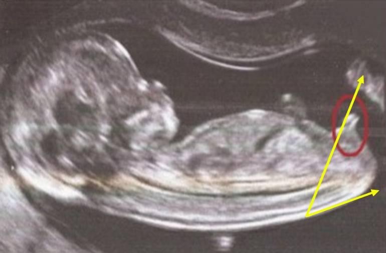 Le foetus est un garçon !